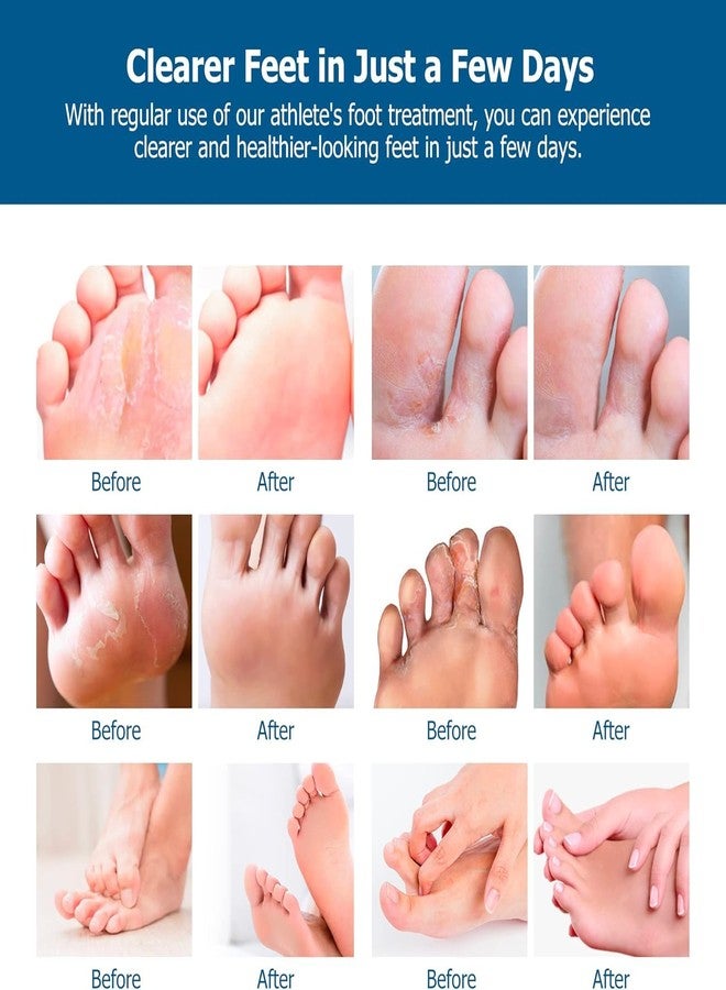 Roycederm Extra Strength Athletes Foot Treatment Cream - Powerful Antifungal Relief for Itching and Burning - Suitable for Men and Women - Image 5